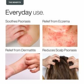 PURETIVE Psoricare Body Oil | Psoriasis and Eczema Relief | Skin Allergies & Rashes | Eczema-Prone & Sensitive Skin Moisturizing Oil | Fast Absorbing | For Daily Use | SCALP+ BODY | For 7yrs+ (100ml) - Image 2