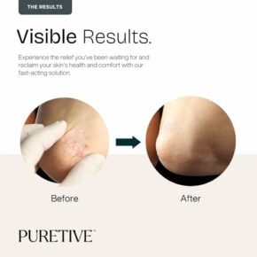 PURETIVE Psoricare Body Oil | Psoriasis and Eczema Relief | Skin Allergies & Rashes | Eczema-Prone & Sensitive Skin Moisturizing Oil | Fast Absorbing | For Daily Use | SCALP+ BODY | For 7yrs+ (100ml) - Image 3
