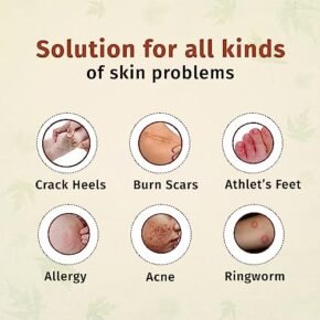 Misti's Ayurvedic Gold Malam for Itching, Rashes, Eczema, Acne, Ringworm, Boils, Allergy, Burn Marks, Crack Heel, Foot care, Fungal Infection, pigmentation, dryness & All types of skin infection with AloeVera, Turmeric, Saffron, Sandalwood, Tulsi, Neem | All Skin Types Men & Women - 15g